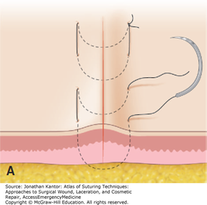 Horizontal Mattress sutures.png